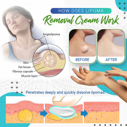 LumpFree™ Lipoma Removal Cream