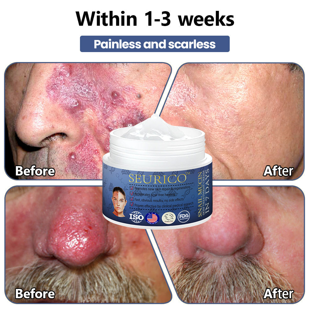 Seurico™ Snail Mucin Skin Treatment Cream (AAD Recommended👨‍⚕️)💖💟