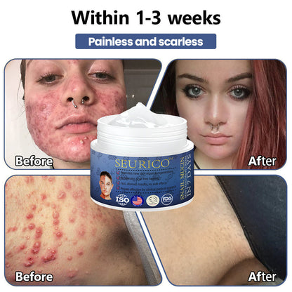 Seurico™ Snail Mucin Skin Treatment Cream (AAD Recommended👨‍⚕️)💖💟