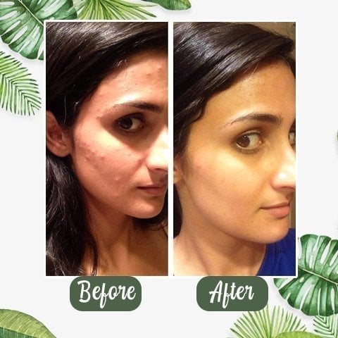 Last Day 75% OFF 🔥🍵Buy 1 Get 1 Free🍵 Deep Cleanse Green Tea Mask