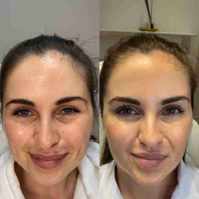 Seurico™™ Power Redo Anti-Aging Blur & Smooth Wrinkle Filler-Last Day Sale 90% OFF 🔥Buy 1 Get 2 Free🔥