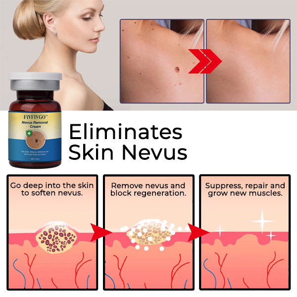 Seurico™ Nevus Removal Cream